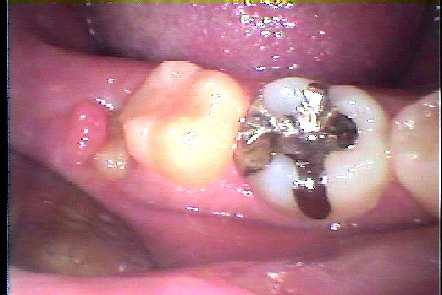 膿 親知らず 抜歯 下の親知らず抜歯後2週間経ちますが、膿が出続けています。また一番奥の