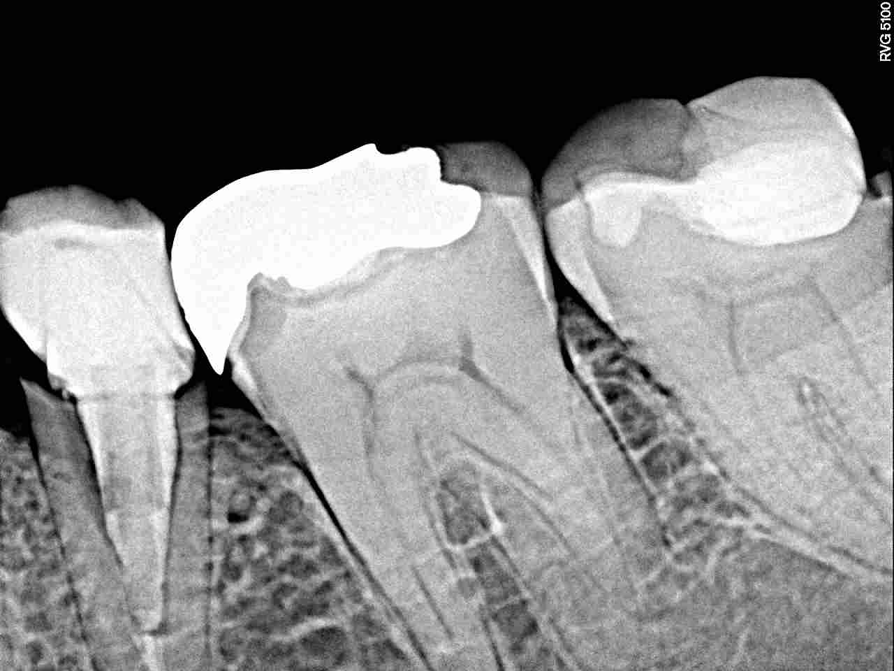 銀 歯 の 下 虫歯 レントゲン