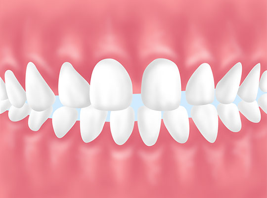 空隙歯列（くうげきしれつ）・すきっ歯
