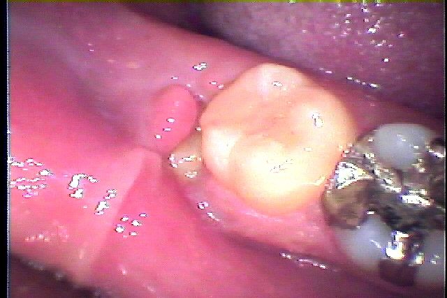 右下の親知らずの抜歯 歯茎が腫れて痛むとのこと｜広島市安佐南区の歯科医院