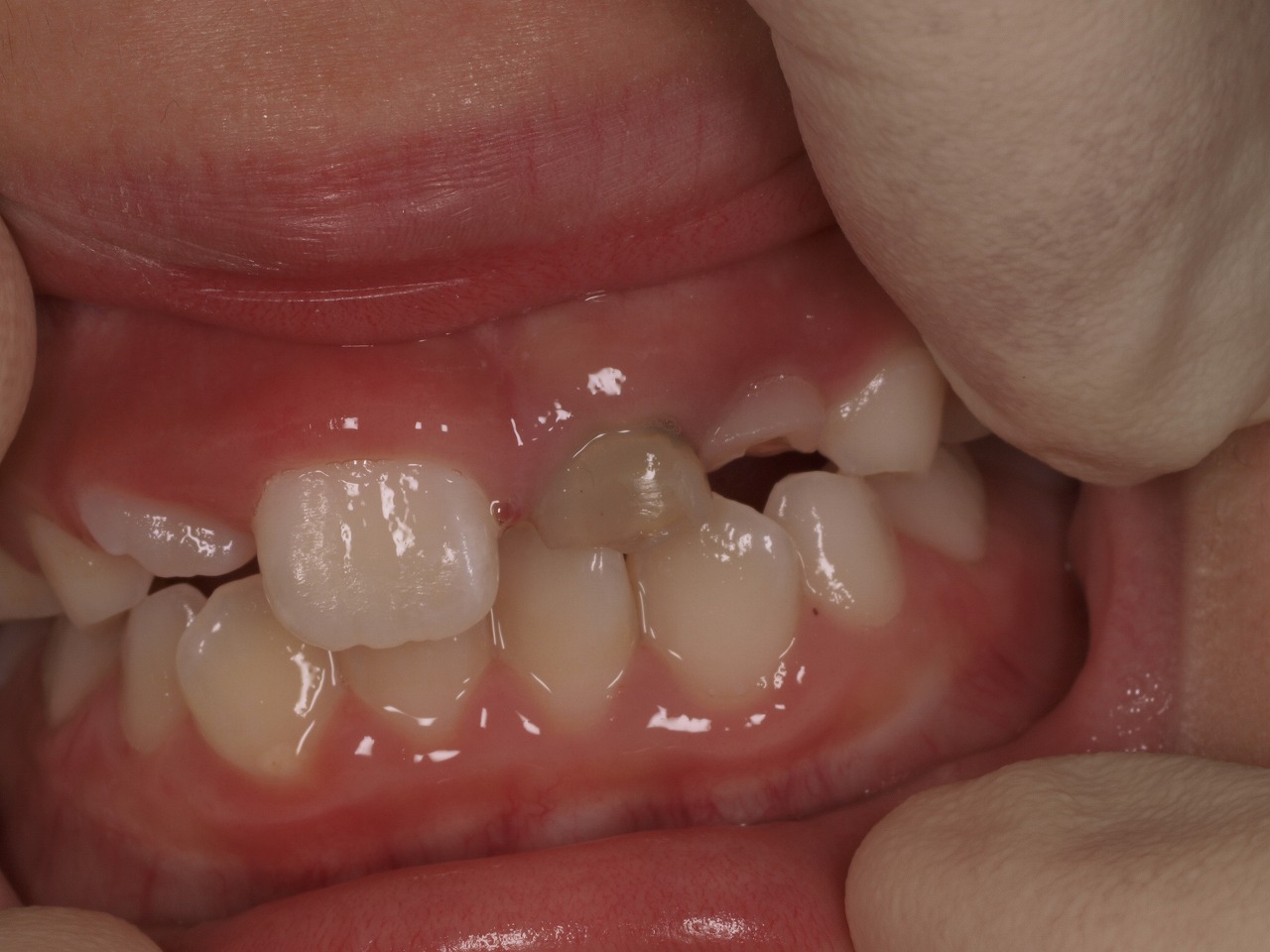 永久歯 が 生え て こない 治療