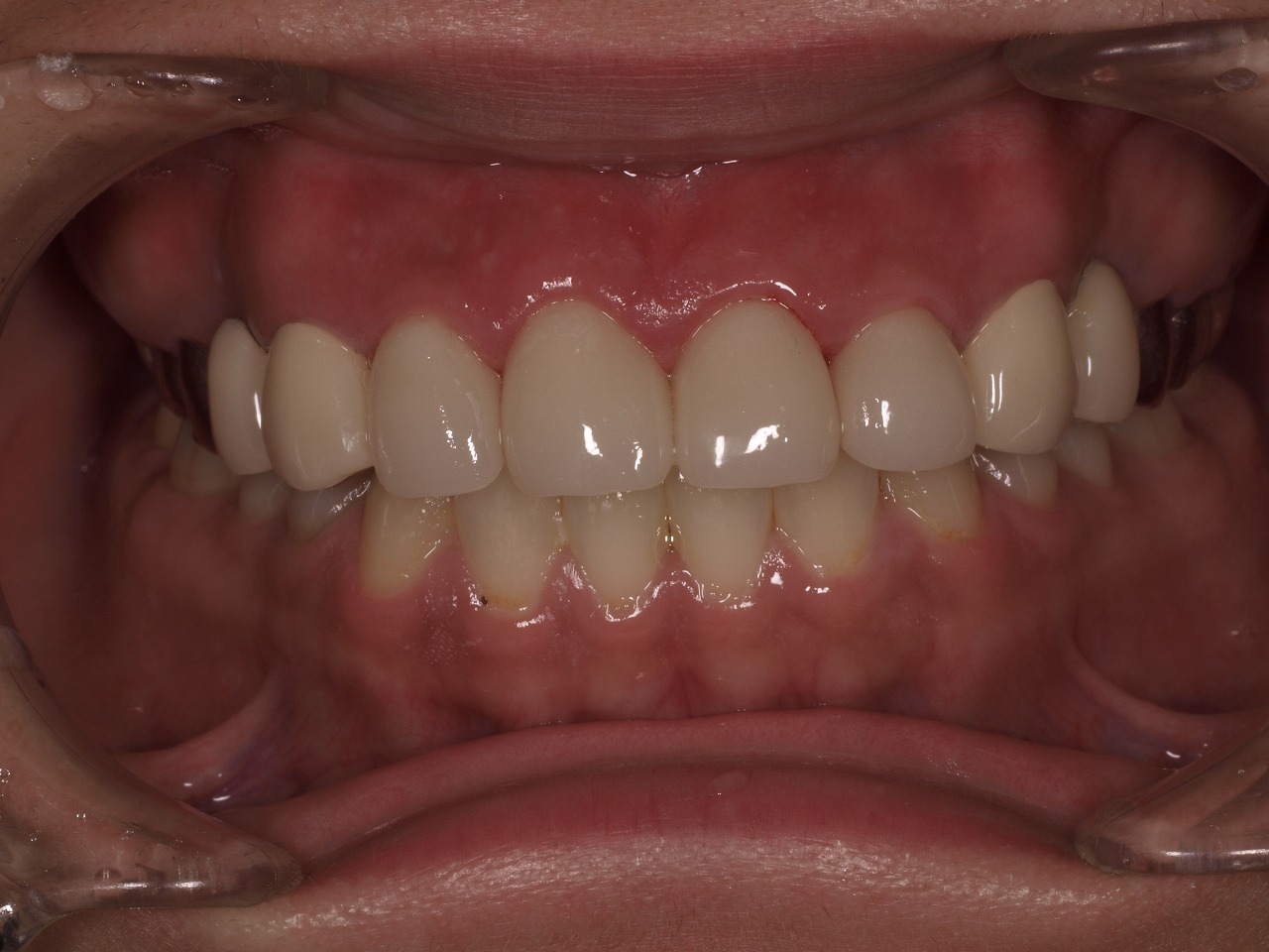すり減っ た 歯 修復