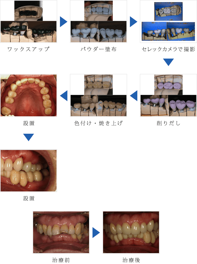 セレック1