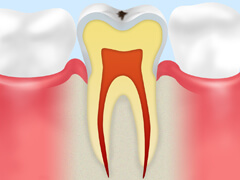 C0初期の虫歯