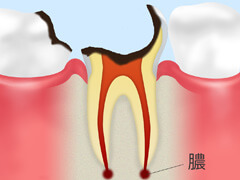 C4歯の根の虫歯