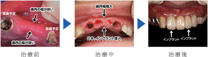 前歯の抜歯即時埋入