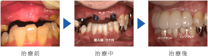 上の前歯の抜歯即時埋入