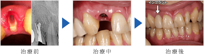 右上の前歯インプラント3