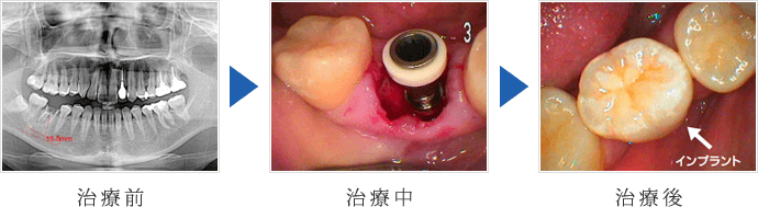 右下の奥歯インプラント