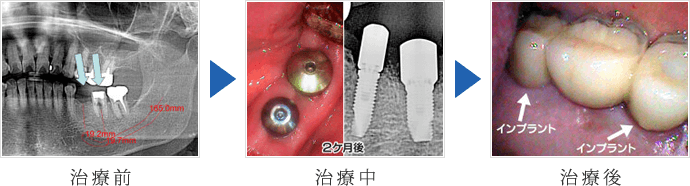 左下の奥歯インプラントと右上の奥歯インプラント