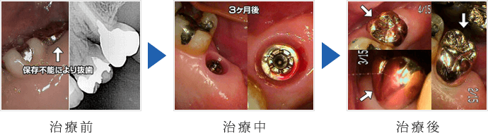 左上の抜歯即時インプラント