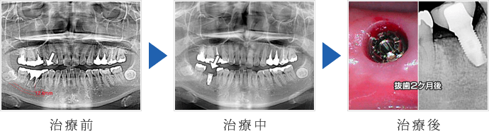 右下の抜歯即時インプラント