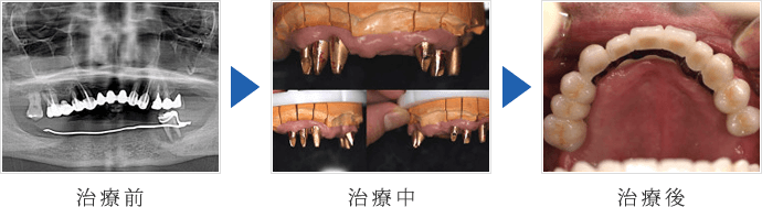 無歯顎のインプラント1