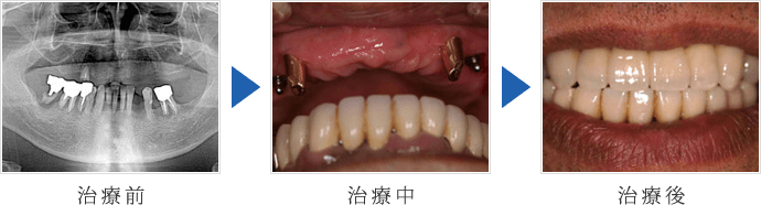 無歯顎のインプラント2