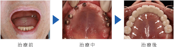 無歯顎のインプラント3