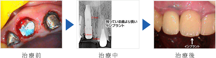 右上の前歯インプラント2