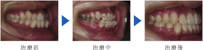 前歯部反対咬合