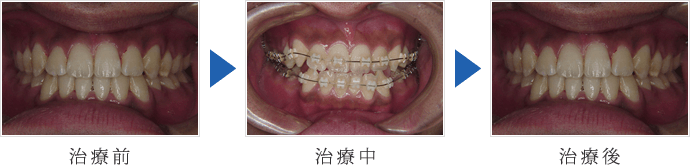 前歯部反対咬合