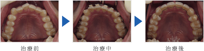 前歯部反対咬合
