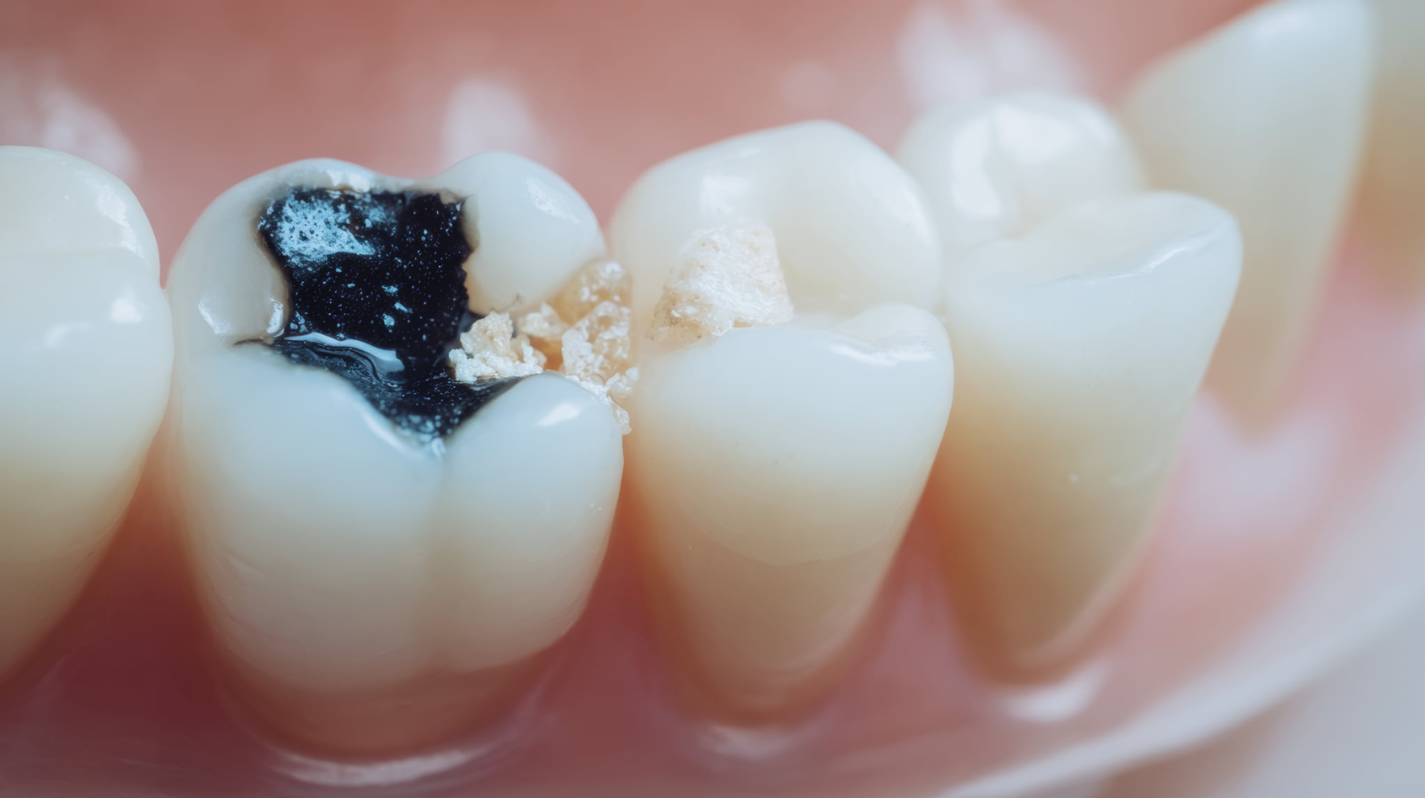 歯が溶けやすく虫歯が進行した子どもの歯