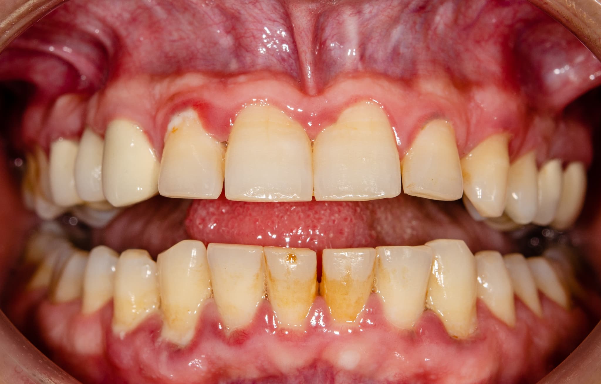 歯石や歯垢が付着している歯と赤くなっている歯ぐき
