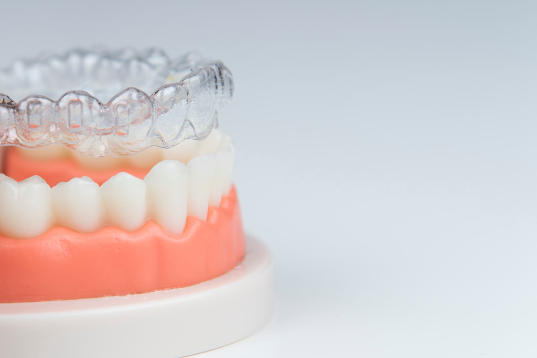 インビザラインで矯正した歯が後戻りするイメージ