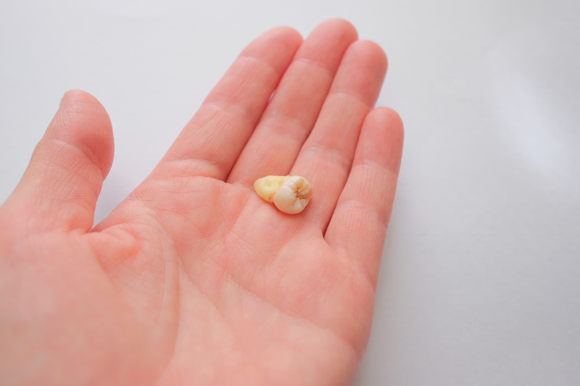 手のひらに乗せた抜いた歯