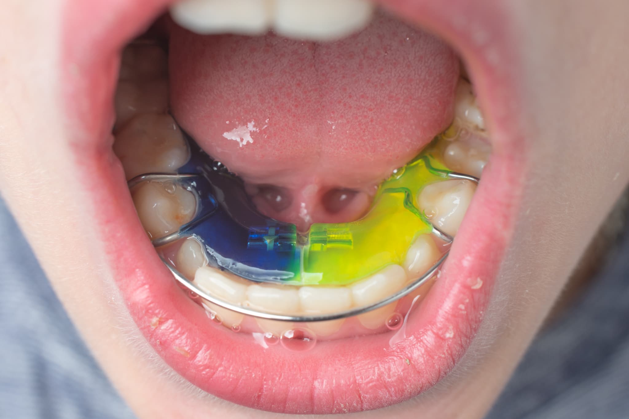床矯正の装置を下あごに装着しているイメージ